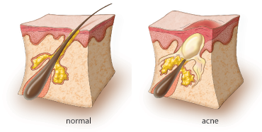 zit pus under microscope