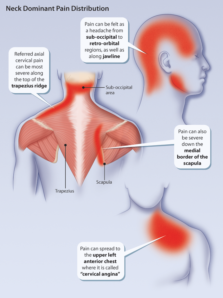 a-pain-in-the-neck-healthplexus