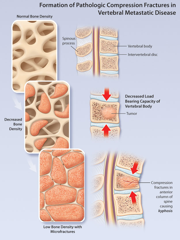 Metastatic Epidural Spinal Cord Compression HealthPlexus