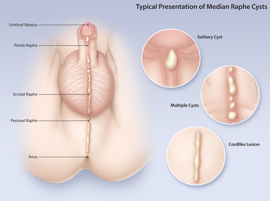 Image result for perineal raphe