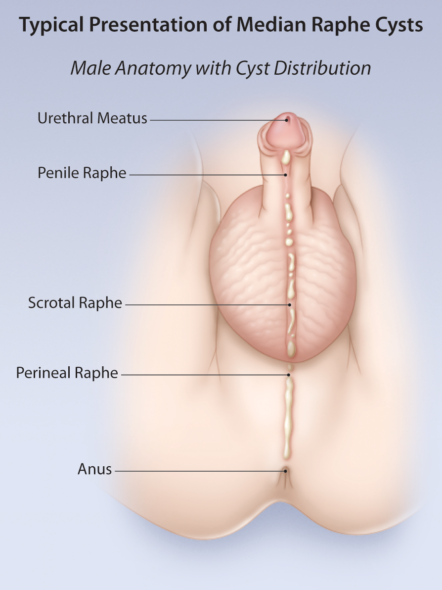 Perineal raphe