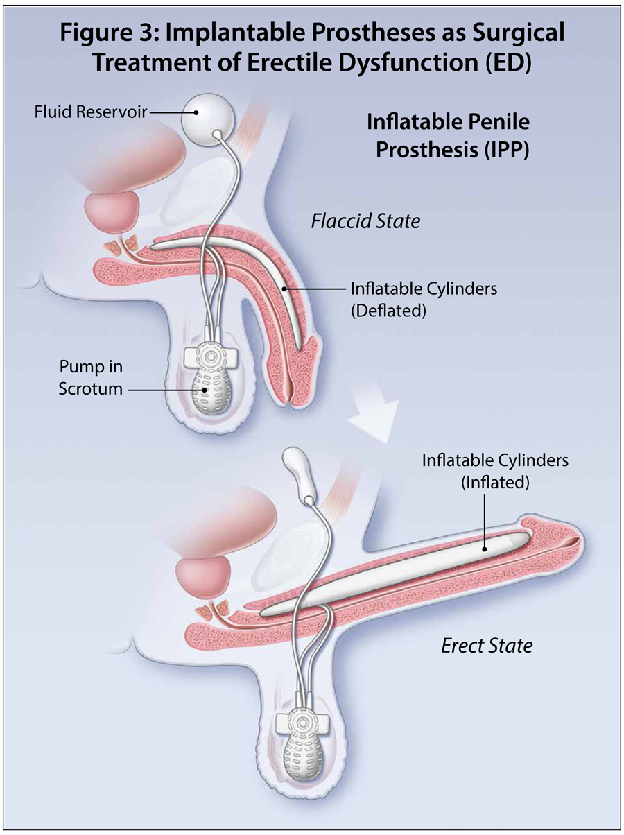 Surgical Management of Erectile Dysfunction Page 5