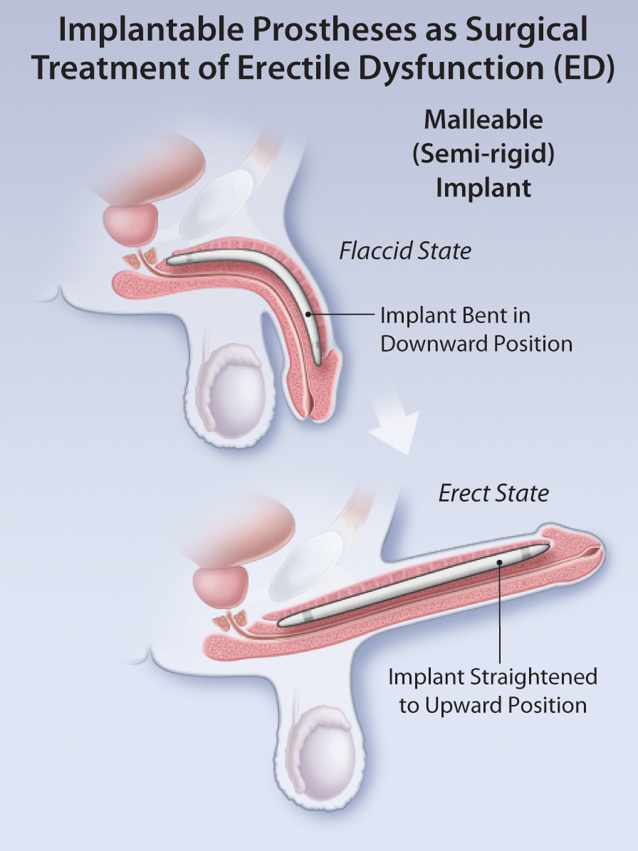 Surgical Management Of Erectile Dysfunction