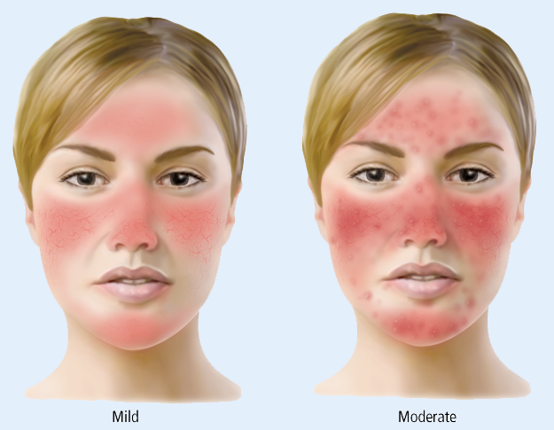 rosacea nose bumps