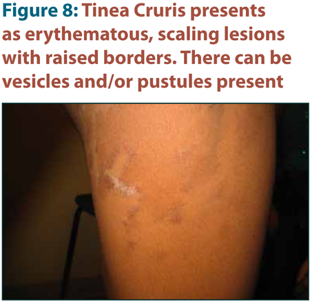 Dermatophyte Infections: A Fungus Among Us? - Page 5