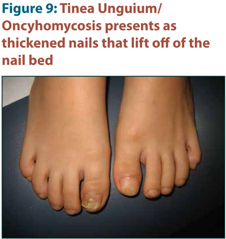 Tinea unguium, also known as onychomycosis. This patient presented with