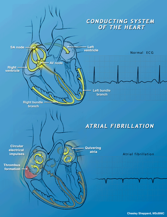 atrial fibrillation image