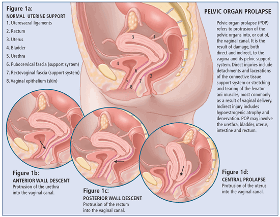 Pelvic Prolapse  Nucleus Health 