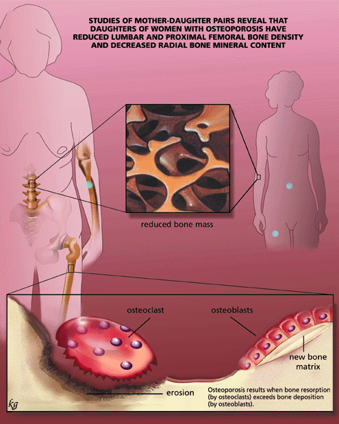 osteoporosis image